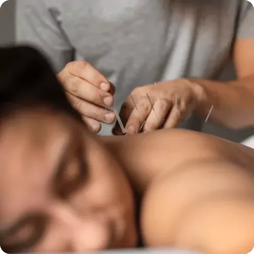 Acupuncture needles being placed during a treatment session